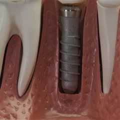 A Comprehensive Guide To Choosing The Right Dentist For Your Dental Implants Procedure In Waco