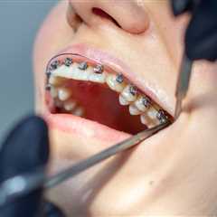 How Long Does It Take to Remove Braces?