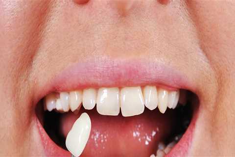 What happens to the teeth under veneers?