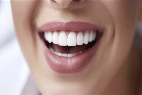 Benefits Of Investing In Quality Dental Veneers In Borger, TX