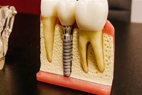 Say Goodbye To Gaps: How Dental Implants In Edmonds, WA Can Transform Your Smile