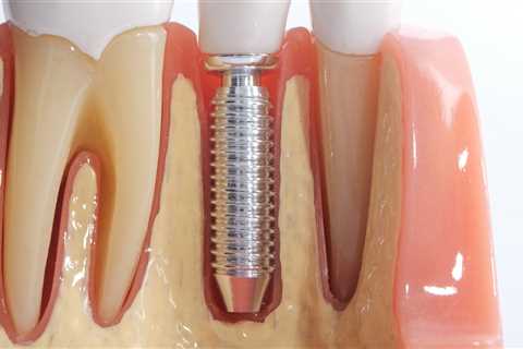 All You Need To Know About Getting Dental Implants In Cedar Park