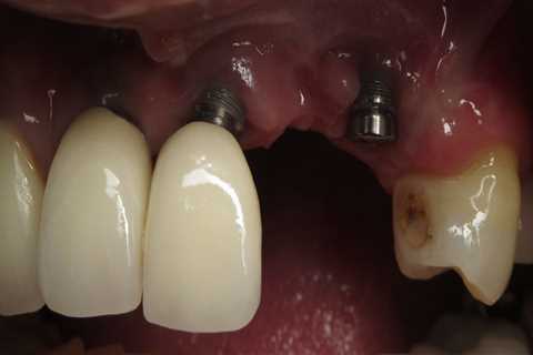 When dental implants fail?