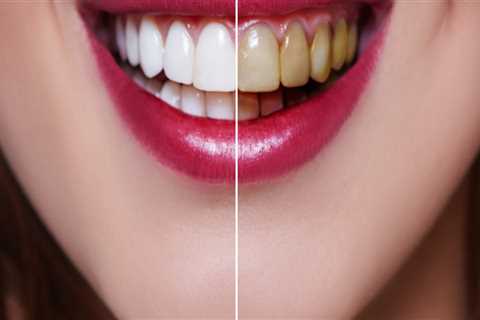 How much does a top row of veneers cost?