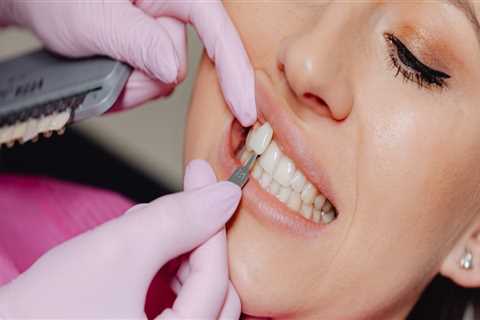 Elevate Your Smile: Exploring Dental Veneers In North Las Vegas