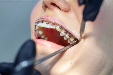 How Long Does It Take to Remove Braces?