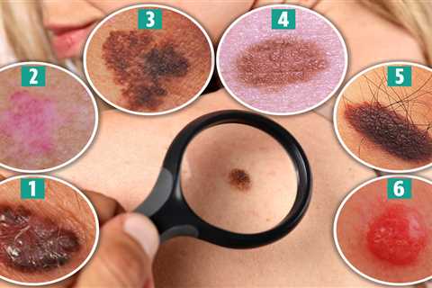 Skin Cancer Signs: What You Need to Know