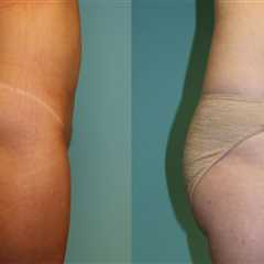 The Benefits Of Visiting A Plastic Surgery Clinic In Chevy Chase For Laser Liposuction Procedures