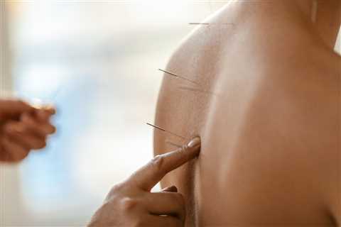 Acupuncture and Sports Medicine: Enhancing Performance and Supporting Recovery