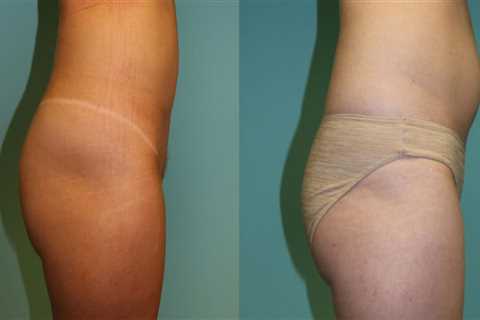 The Benefits Of Visiting A Plastic Surgery Clinic In Chevy Chase For Laser Liposuction Procedures