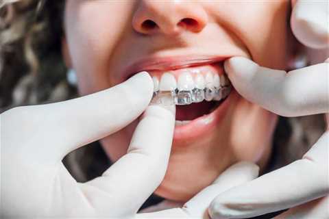 Understanding the Benefits of Invisalign for Teens and Adults