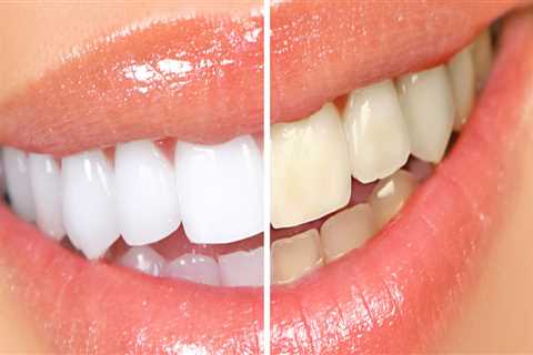 Caring for Teeth After Whitening: Tips and Tricks to Keep Your Smile Bright