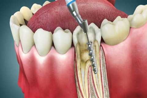 Aftercare for a Root Canal: Tips and Information for Affordable Dental Insurance Coverage