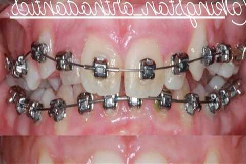 A Comprehensive Overview of Different Types of Orthodontic Treatments