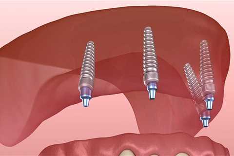 A Comprehensive Guide to Getting Affordable Dental Implants