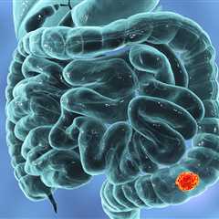 Diet Identified as Main Driver of Bowel Cancer Risk Among Young People