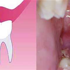 Is Wisdom Tooth Extraction Painful? An Expert's Perspective