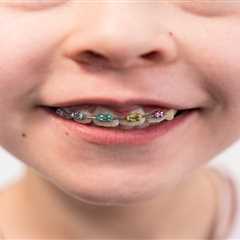 Top Benefits of Early Braces for Kids in Marietta