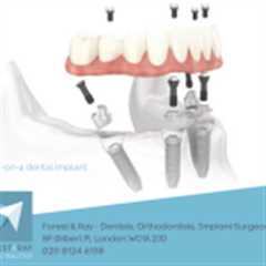 All on 4 Dental Implants Wimpole Street