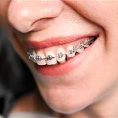 How to Make Braces Comfortable for Your Teen in Marietta