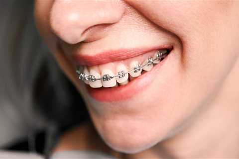 How to Make Braces Comfortable for Your Teen in Marietta