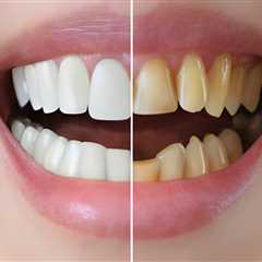 Transform Your Smile: Understanding The Cost Of Braces For A Smile Makeover In Summerville