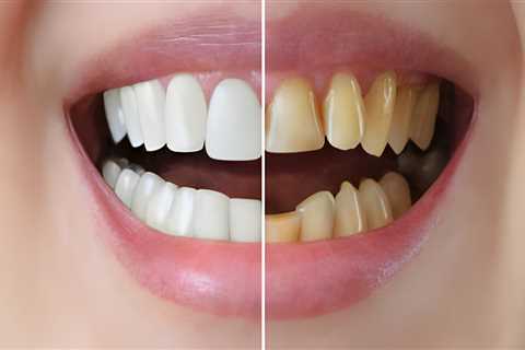 Transform Your Smile: Understanding The Cost Of Braces For A Smile Makeover In Summerville