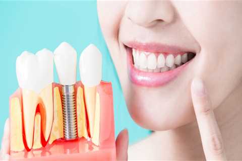 Restoring Confidence: The Importance Of Dental Implants For A Complete Smile In Ashburn