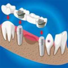 Dentistry Bridges vs Implants: Which Tooth Replacement Option Is Best for You?