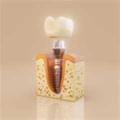 What Is a Dental Implant Made Of? Materials and Benefits