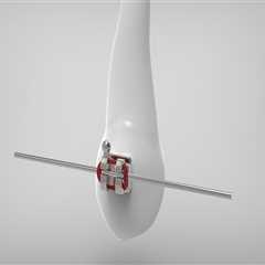 Wisdom Teeth Removal and Braces: A Guide to a Healthier Smile