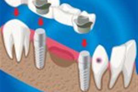 Dentistry Bridges vs Implants: Which Tooth Replacement Option Is Best for You?