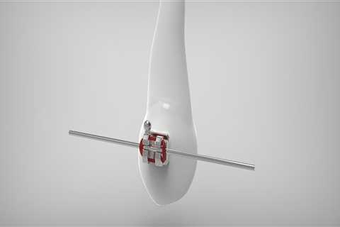 Wisdom Teeth Removal and Braces: A Guide to a Healthier Smile