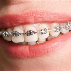 Your First Week with Metal Orthodontic Braces: What to Expect