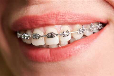 Your First Week with Metal Orthodontic Braces: What to Expect