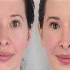 Refresh Your Look with Botox at Cheeky Denver