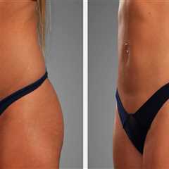 Enhance Your Post-Laser Liposuction Results with Retinol