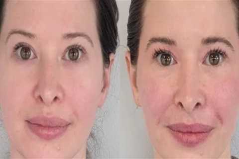 Refresh Your Look with Botox at Cheeky Denver
