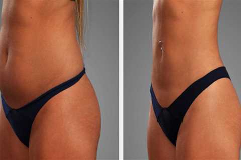 Enhance Your Post-Laser Liposuction Results with Retinol