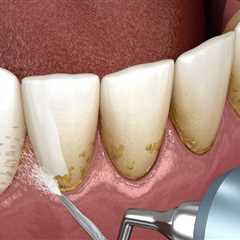 Understanding Teeth Cleaning with a History of Gum Disease