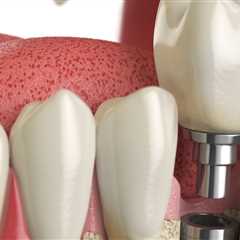 Preparing for Your Dental Implants Consultation
