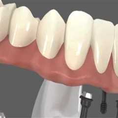 Recovery Timeline After Receiving All-on-Four Dentures