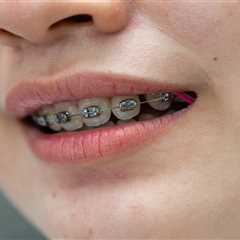 How Herndon Orthodontists Help Teens and Adults Achieve a Straighter Smile