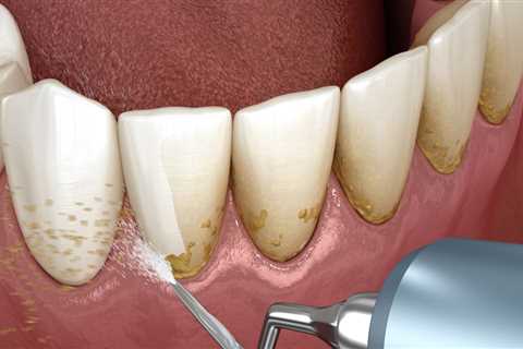 Understanding Teeth Cleaning with a History of Gum Disease