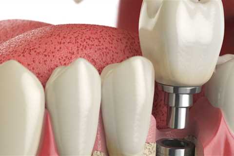 Preparing for Your Dental Implants Consultation