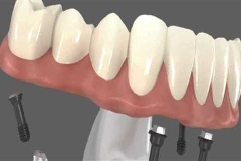 Recovery Timeline After Receiving All-on-Four Dentures