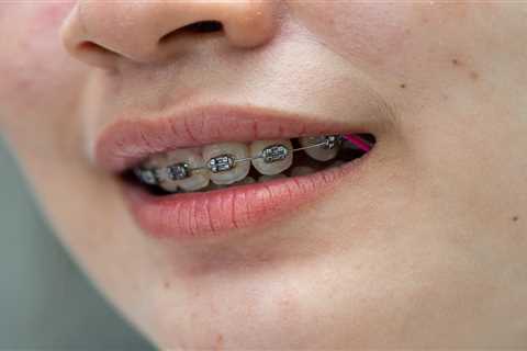 How Herndon Orthodontists Help Teens and Adults Achieve a Straighter Smile